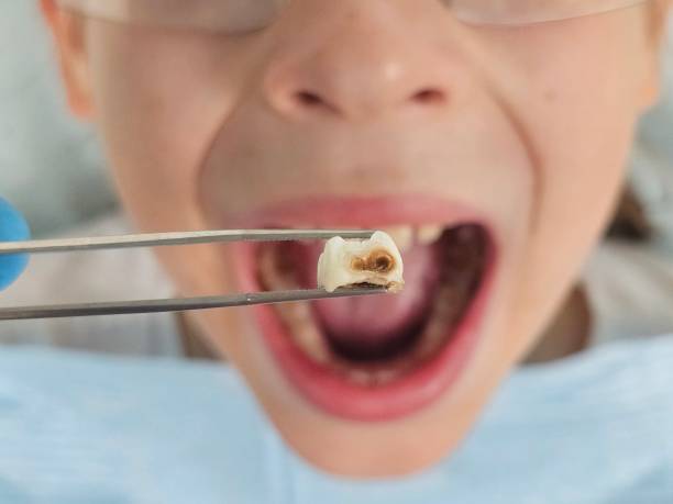 Best Tooth Infection Emergency Dentist  in El Lago, TX